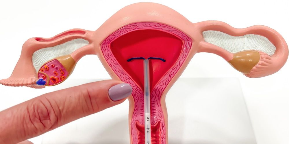 imagen de un diu insertado en una vagina de plástico